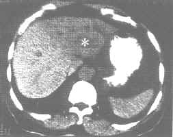 末梢型胆管癌（CT平扫）