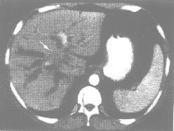 肝门部胆管细胞癌（CT增强）