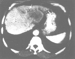 末梢型胆管癌（CT增强）