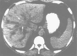 肝门部胆管细胞癌（CT平扫）