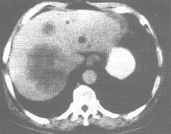 转移性肝癌（CT增强）