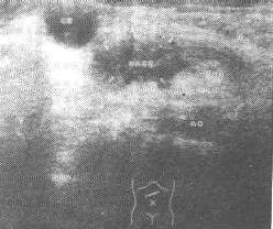 胰头、钩突部癌(B超)