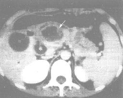粘液性囊腺癌(CT增强)