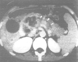 粘液性囊腺癌(CT增强)