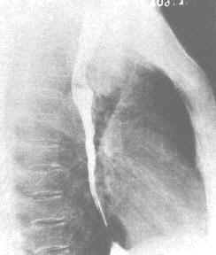 胸内甲状腺肿(胸片)