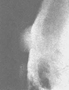 致密型骨瘤(切线位)