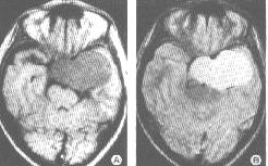 MRI