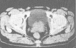 ǰٰCT