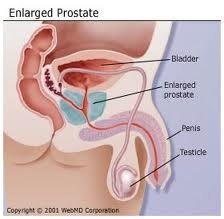 Enlarged Prostate
