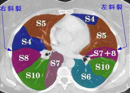 正常胸部ct肺段划分
